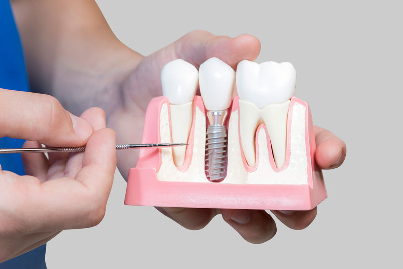 Dental Assistant Showing Off A Dental Implant In A Jawbone Cutaway Model in Miami, FL