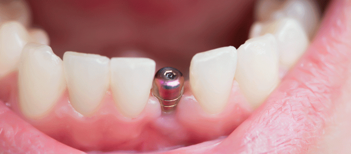 close up shot of a patient’s mouth with a single implant