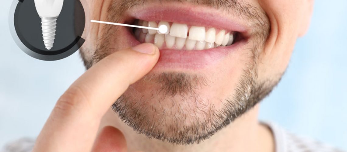 The image shows a close-up of a smiling person's lower face, highlighting their teeth. A finger is pointing to one of the teeth, and there is an inset graphic of a dental implant next to the area being pointed at.
