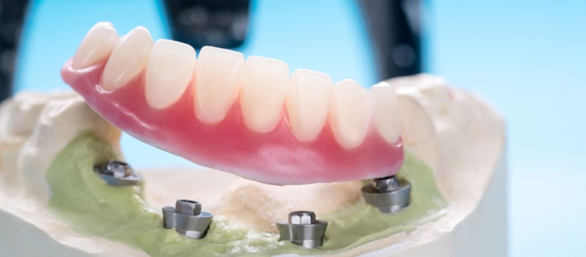 an implant supported denture model all on four implant posts.