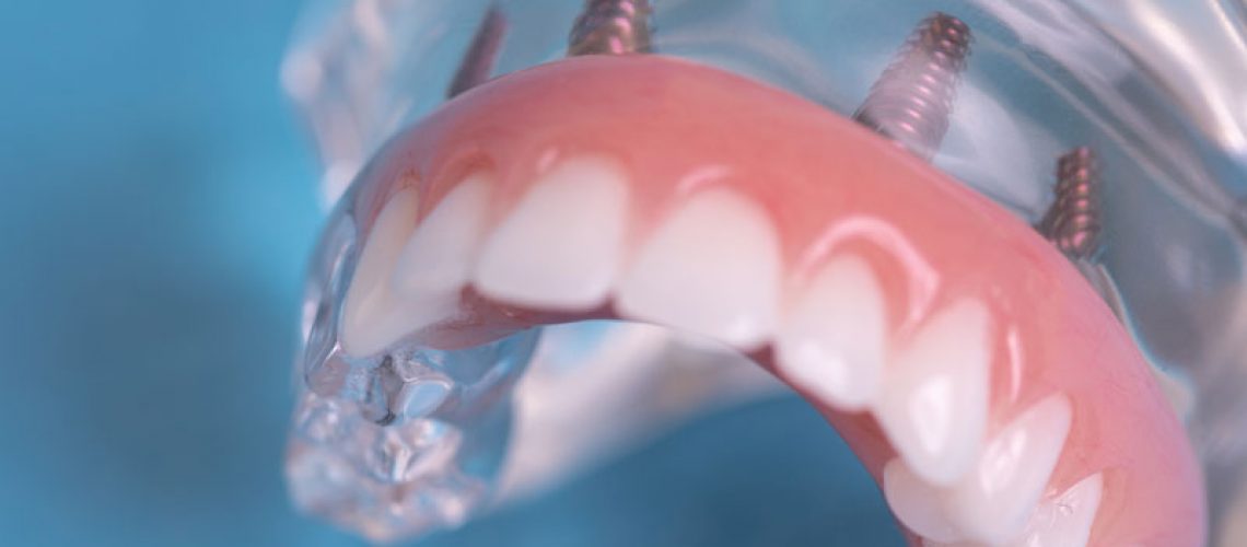 Full Arch Dental Implant Denture Model